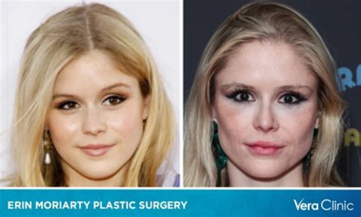 Did Erin Moriarty Get A Nose And Lips Done? Plastic Surgery ·