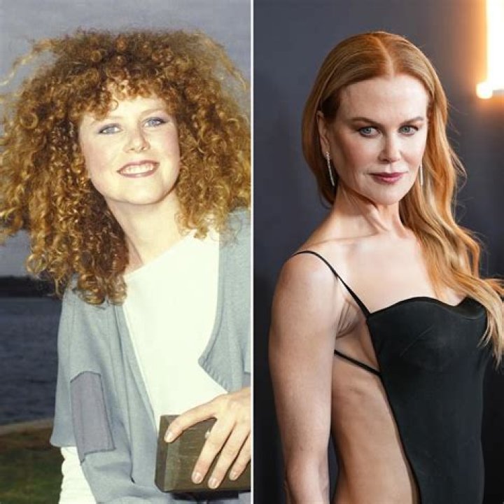 Nicole Kidman Facelift | Plastic Surgery Before And After ·