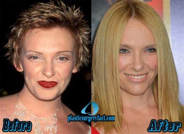 Toni Collette Teeth Before And After