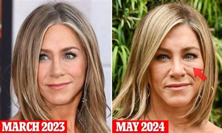 Unveiling Jennifer Aniston's Plastic Surgery Journey: Discoveries And Insights Unveiled