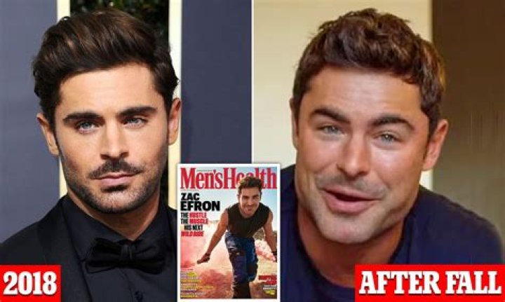 Unveiling Zac Efron's Face Surgery: Insights And Revelations